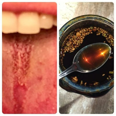 How Swedish Bitters can help when suffering from Candida.